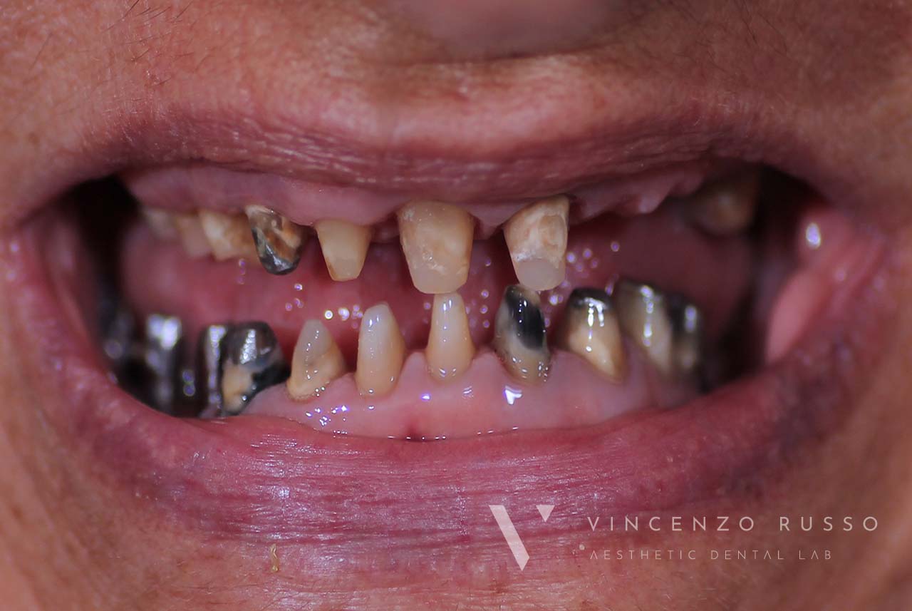 Dopo - Caso Clinico - Impianto Dentale estetico - Studio Odontoiatrico Vincenzo Russo