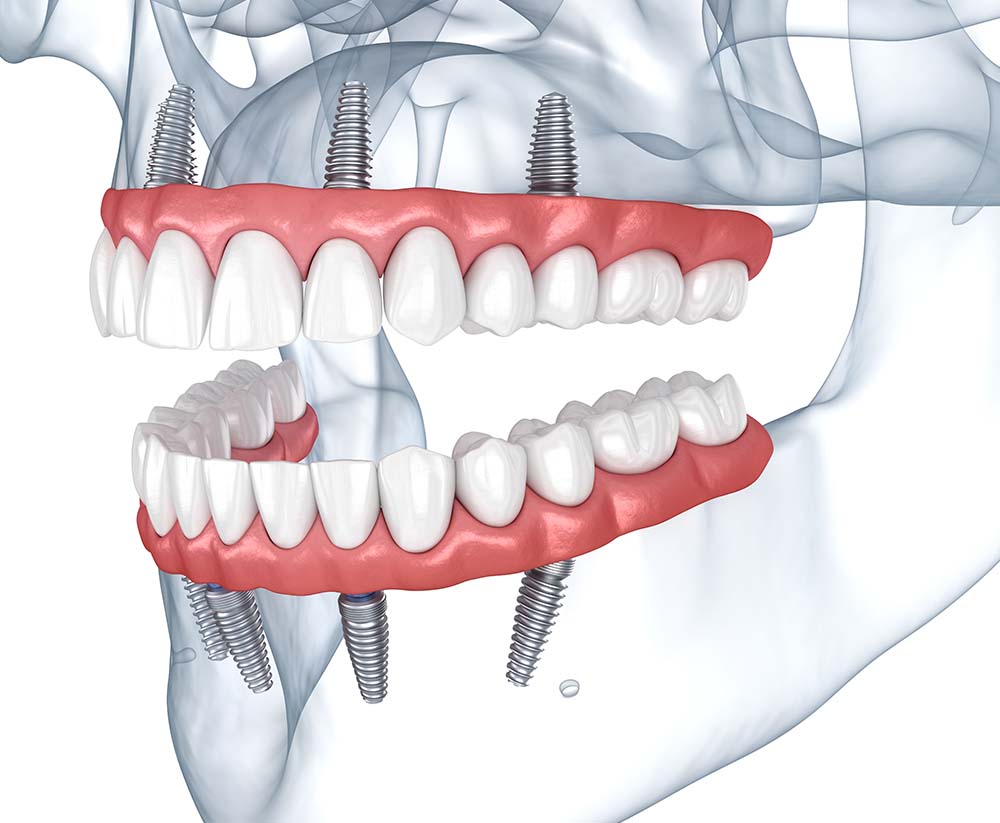 Riabilitazioni con impianti a Carico Immediato e Protesi Dentali multiple - Studio Odontoiatrico Dr Vincenzo Russo - Roma San Giovanni