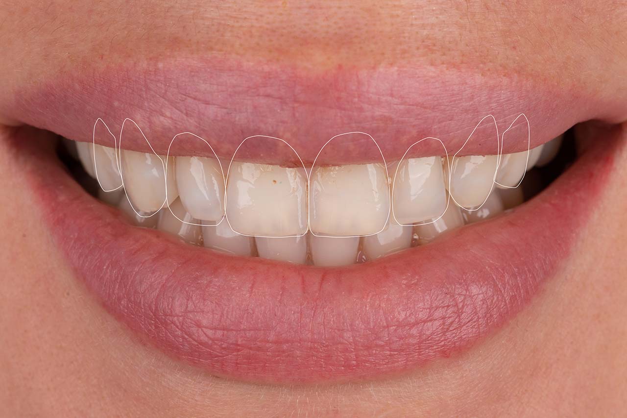 Quando Sono Indicate le Faccette Dentali - Studio Odontoiatrico Dr Vincenzo Russo - Roma San Giovanni