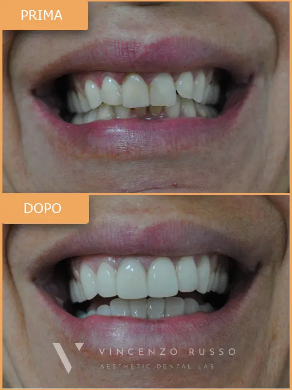 Russo - Faccette dentali