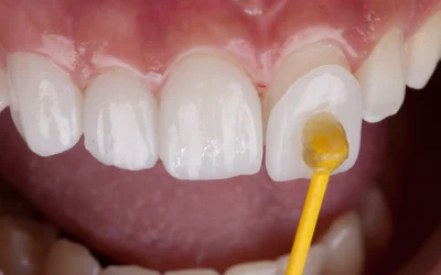 Quanto Costano le Faccette Dentali a San Giovanni? Prezzi e Preventivi Trasparenti | Dr. Vincenzo Russo