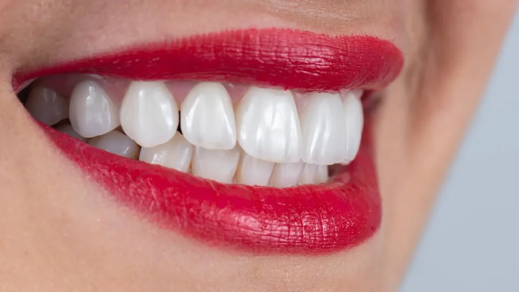 Vincenzo Russo - Faccette dentali