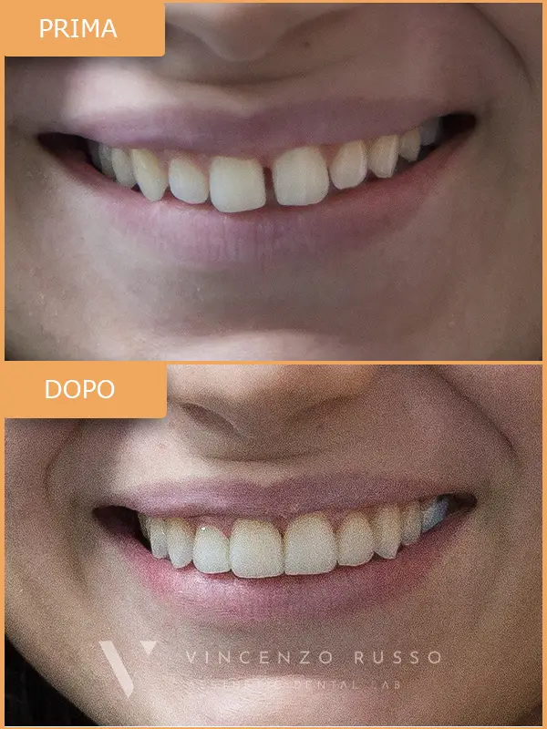 Russo - Faccette dentali