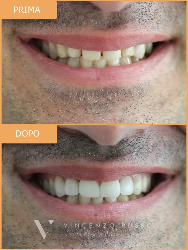 Russo - Faccette dentali