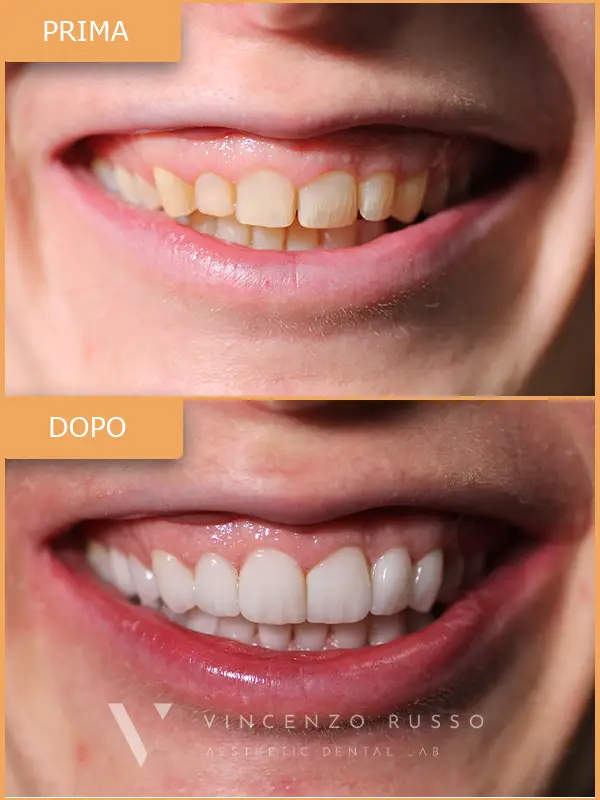 Russo - Faccette dentali