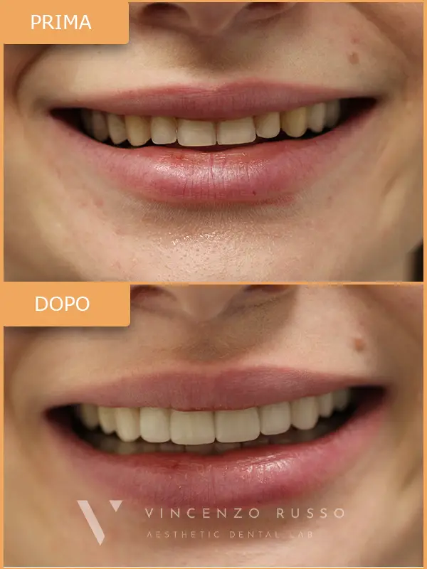 Russo - Faccette dentali
