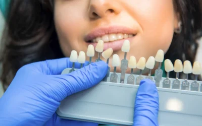 Faccette in Ceramica o Composito? La Guida Che Nessuno Ti Ha Mai Dato per Scegliere Davvero Bene