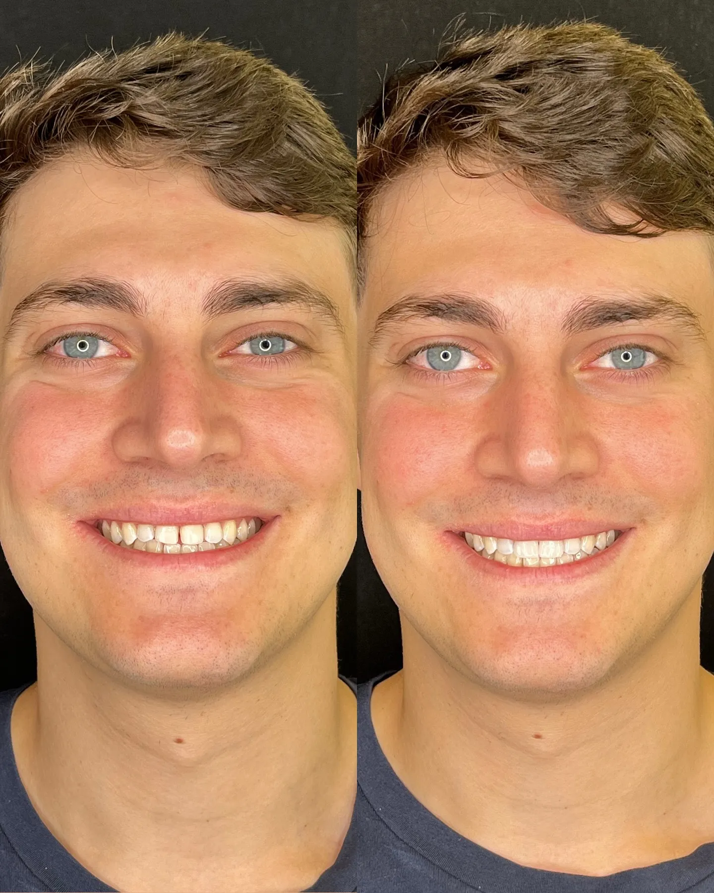 Caso clinico prima e dopo - Sorriso perfetto