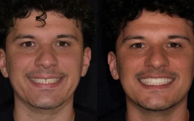 Chiusura del diastema a Roma: come eliminare lo spazio tra i denti con la Injection Technique