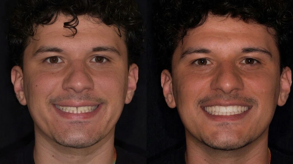 Chiusura del diastema a Roma: come eliminare lo spazio tra i denti con la Injection Technique