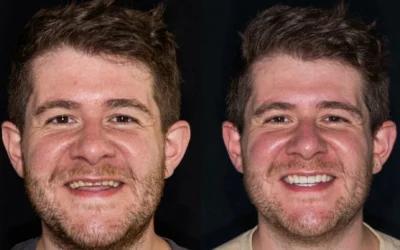 Usura dentale da bruxismo a Roma: come ricostruire forma e funzione del sorriso